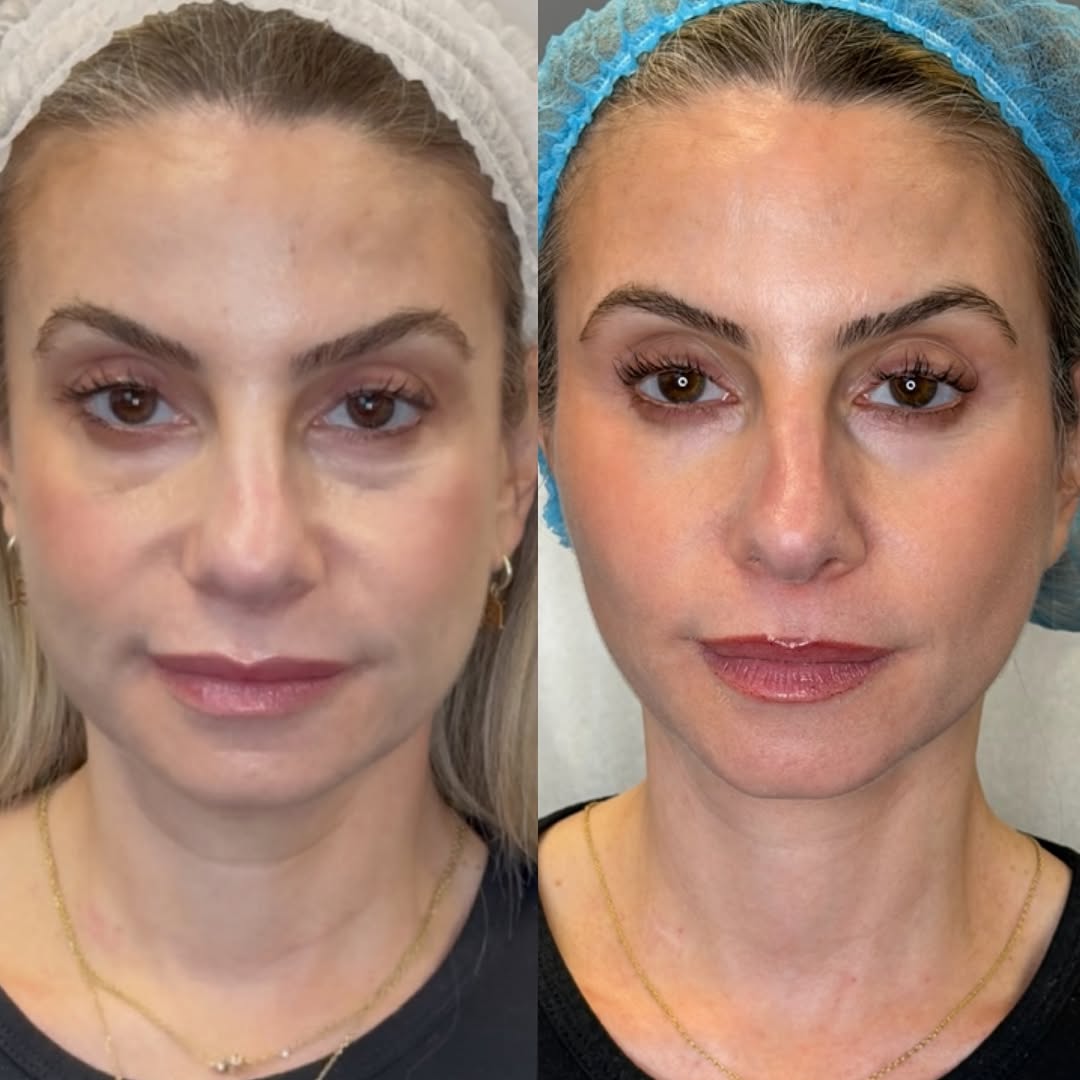 Under-eye and midface, before and after, a patient of Dr. Adam Mauer
