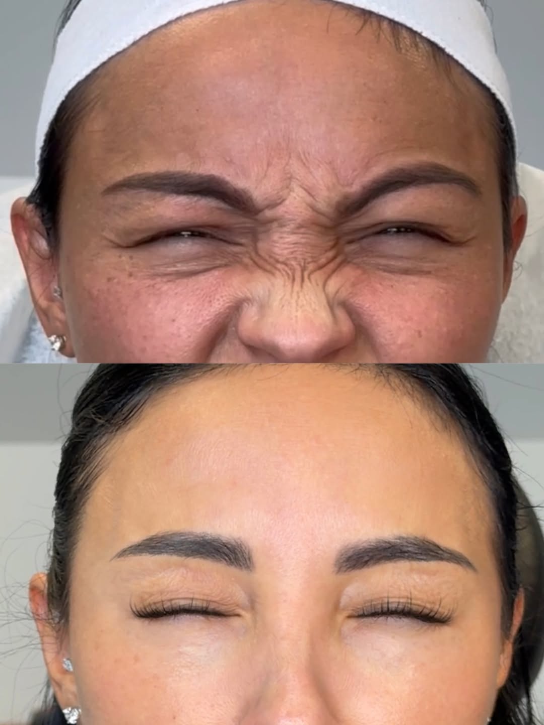 Crow's feet, eyes closed hard, before and after, a patient of Dr. Adam Mauer
