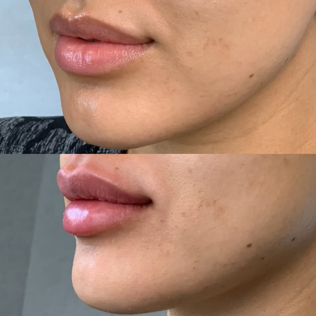 Lip border and chin, before and after, a patient of Dr. Adam Mauer