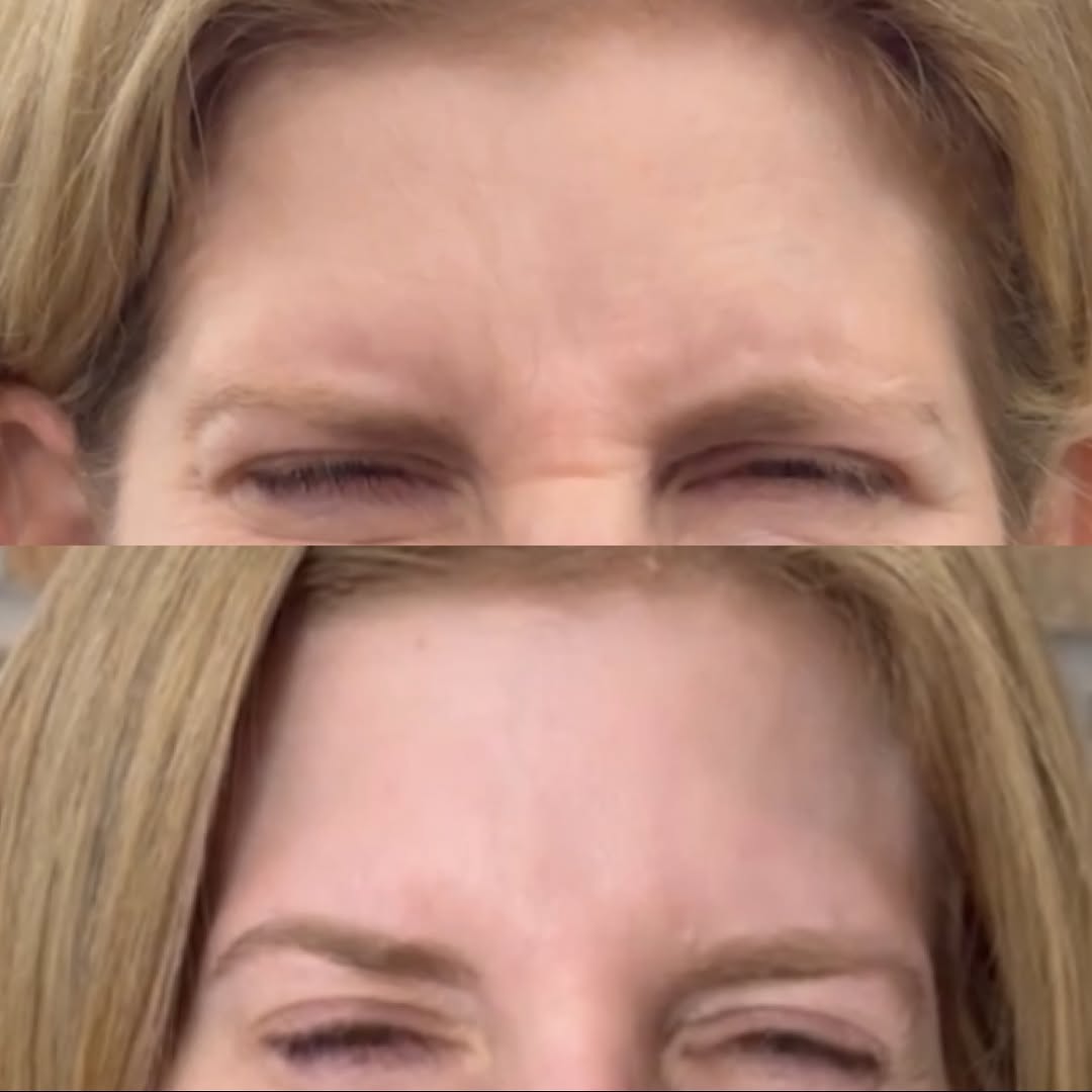 Frown lines, the 11s, before and after, a patient of Dr. Adam Mauer