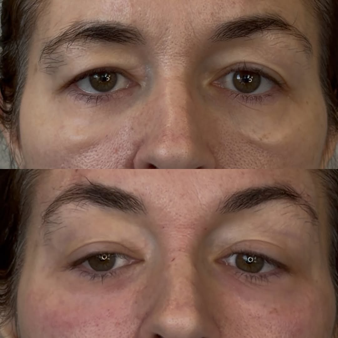 Under-eye correction after bad filler, before and after, a patient of Dr. Adam Mauer