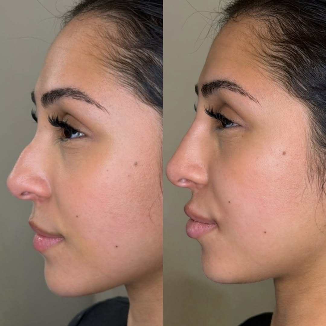 Non-surgical rhinoplasty, before and after, a patient of Dr. Adam Mauer