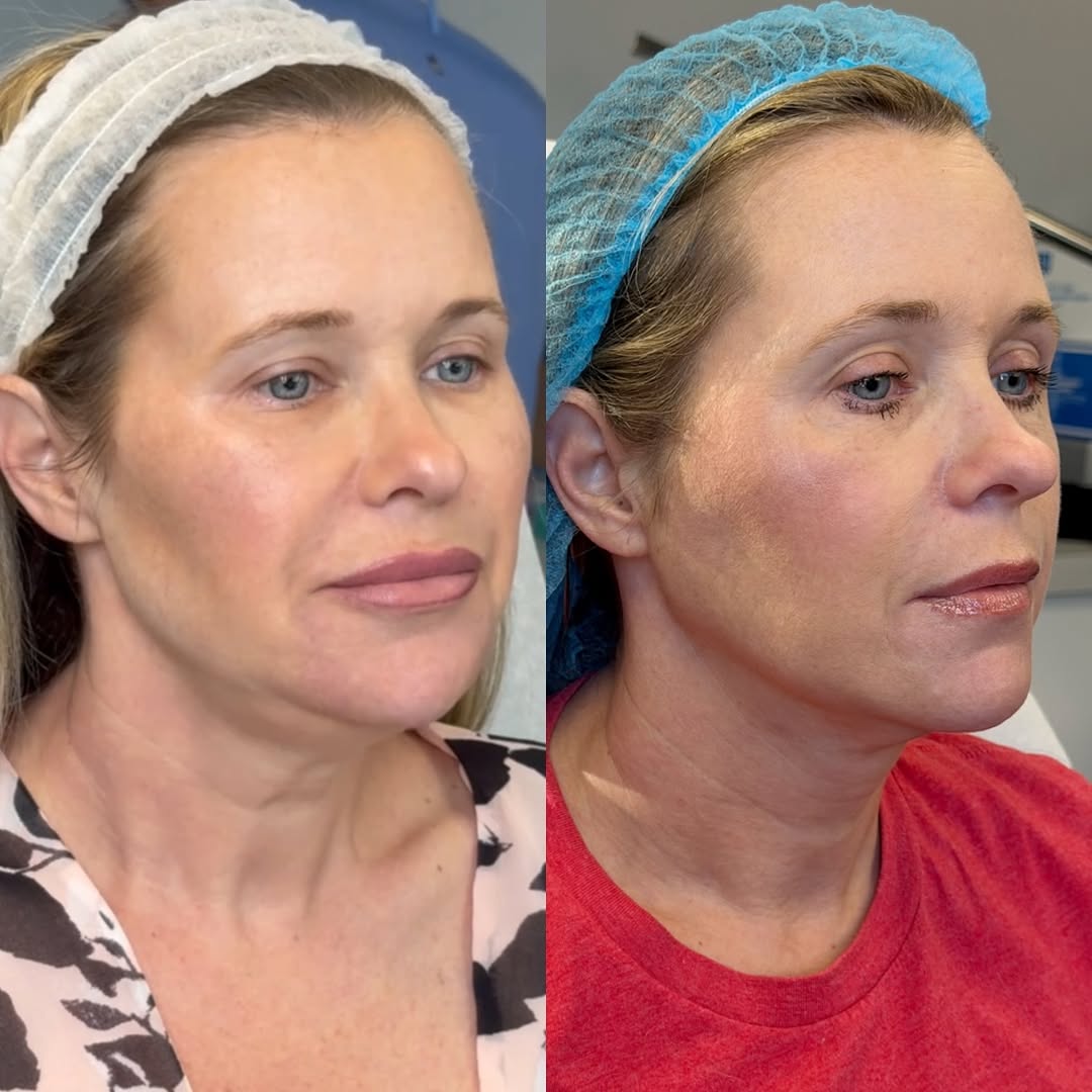 Corrective, over months, before and after, a patient of Dr. Adam Mauer