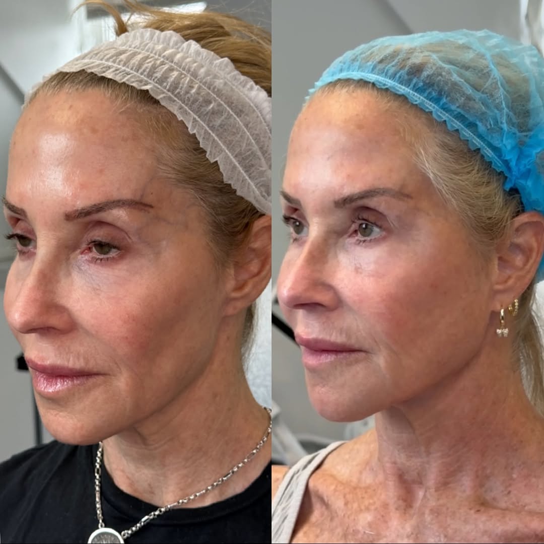 Botox revision, before and after, a patient of Dr. Adam Mauer