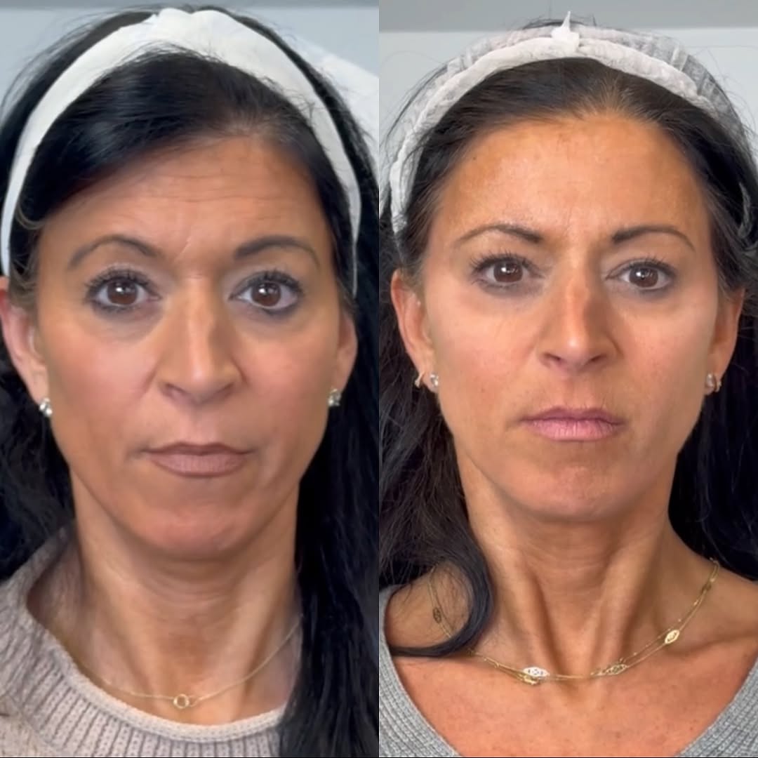Botox and filler, before and after, a patient of Dr. Adam Mauer